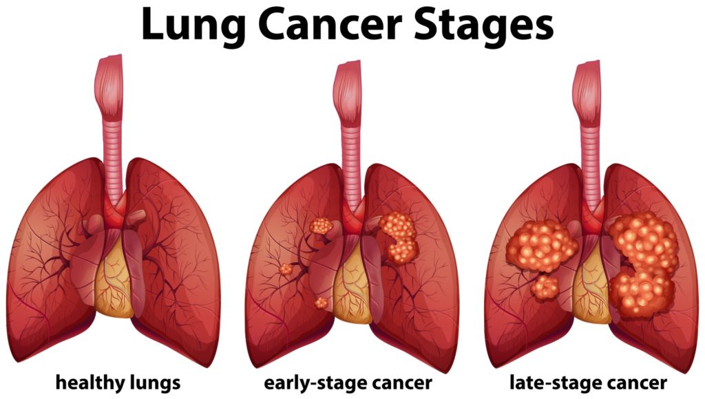 Stages of the Lung Cancer