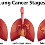 Lung Cancer