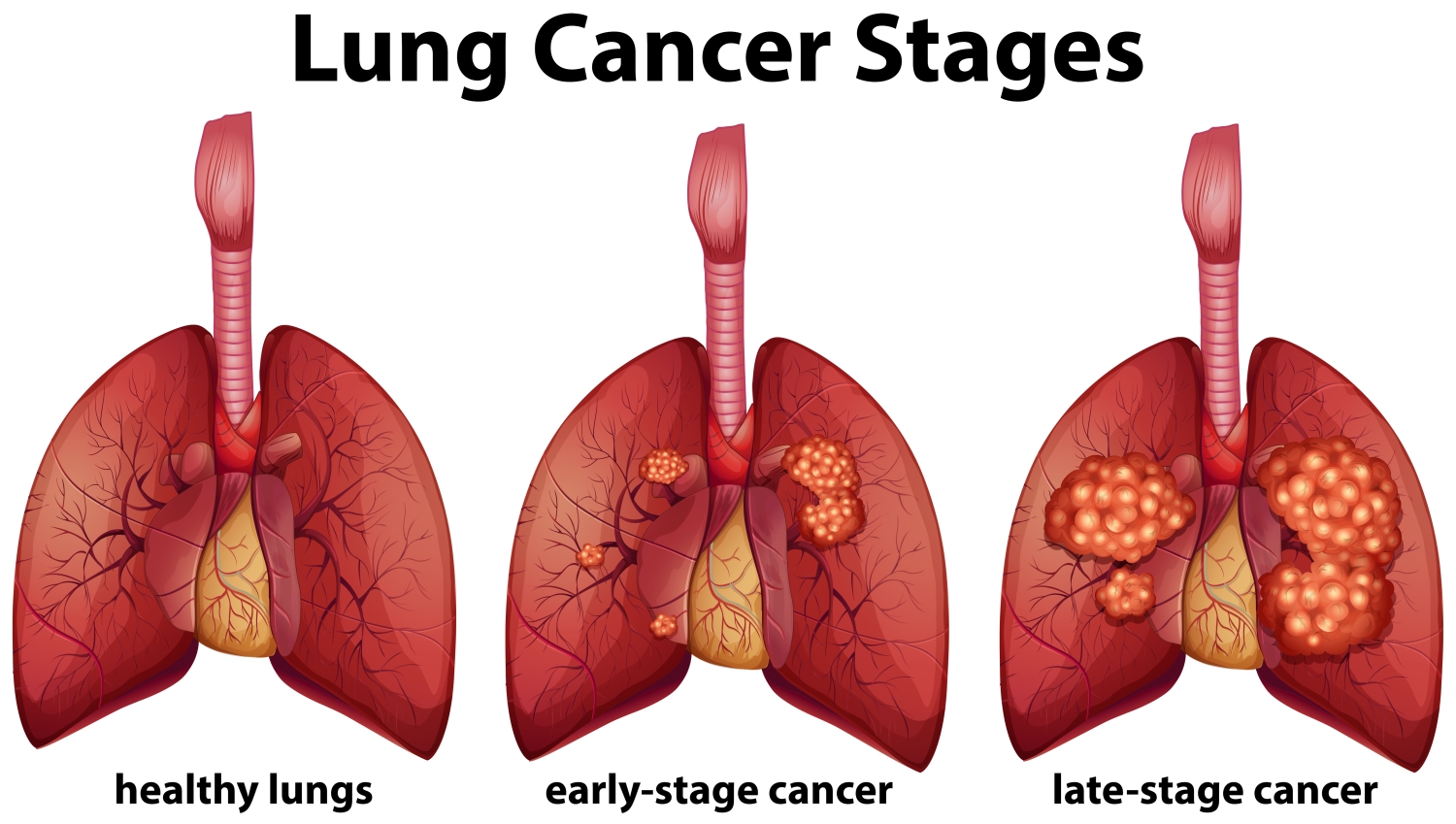 lung-cancer-what-is-lung-cancer-and-how-to-prevent